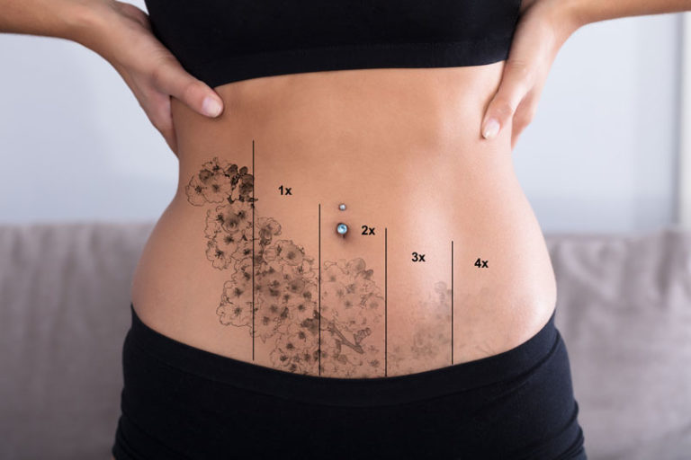 Détatouage