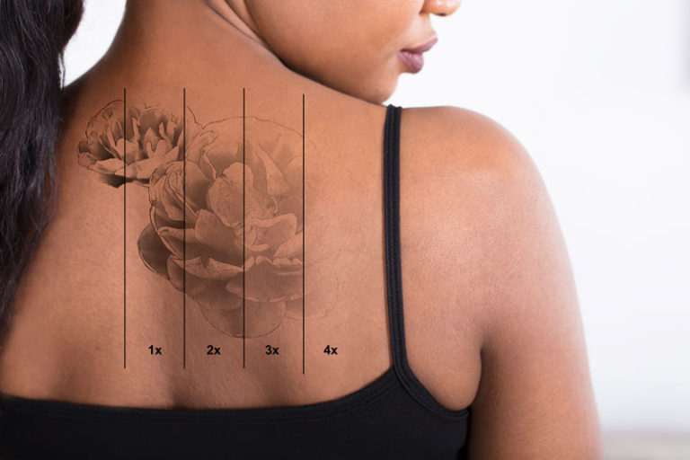 Détatouage
